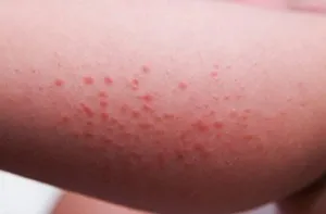 алергія на апельсини