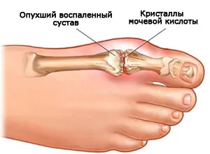 Артрит пальців ніг: симптоми, діагностика та лікування як лікувати артрит ніг
