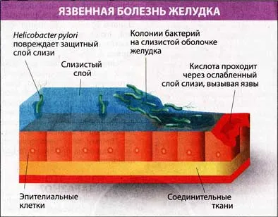 Бережіть шлунок бактерію helicobacter pylori