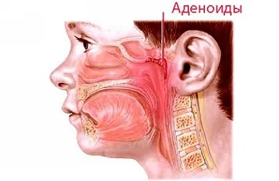 як лікувати аденоїди у грудничка