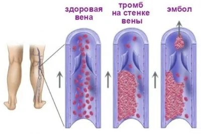 як лікувати атеросклероз ніг