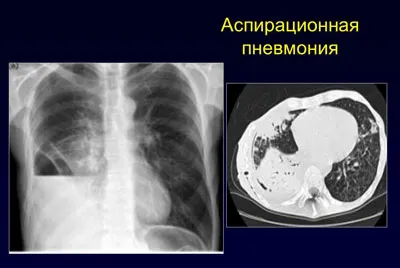 як лікувати аспирационную пневмонію