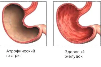 вогнищевий атрофічний гастрит що це таке