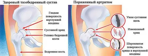 артрит тазостегнового суглоба симптоми і лікування