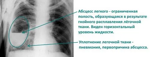 як лікувати абсцес легенів