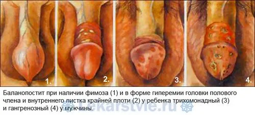 як лікувати баланопостит фурациліном