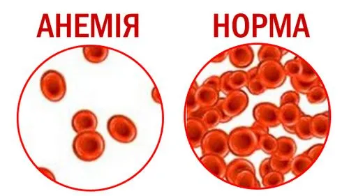 анемія симптоми і лікування у дорослих жінок