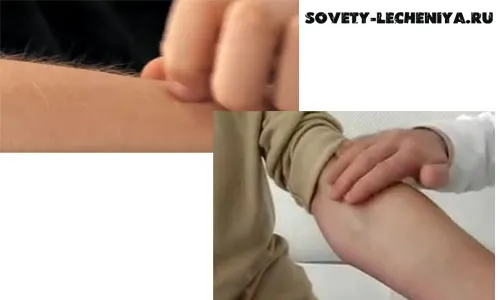 як лікувати кропивницю якщо годуєш грудьми