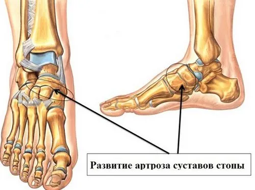як лікувати артроз стопи в домашніх умовах