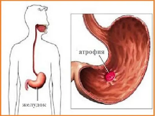 атрофічний гастрит
