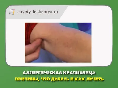 як лікувати кропивницю якщо годуєш грудьми