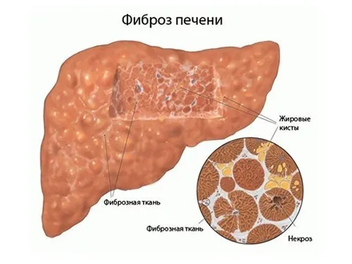 гепатит а ніж лікувати