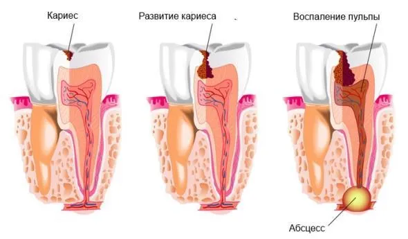 протези