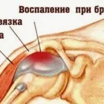 як лікувати бурсит плечового суглоба