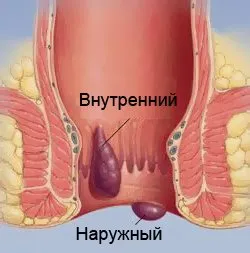 де вилікувати геморой