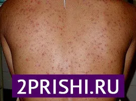як лікувати прищі по всьому тілу