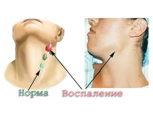 як лікувати лімфовузли на щелепи