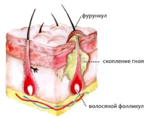 Чиряк - як лікувати? чірь