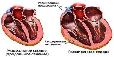як лікувати остеохондроз в області серця