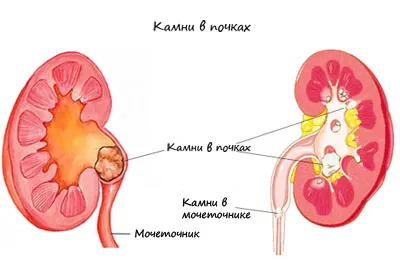 як лікувати нирки болять