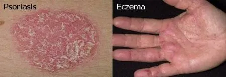 як лікувати псоріаз і екзему