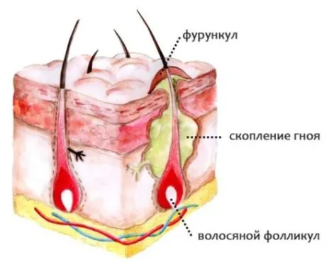 лікувати фурункул на голові