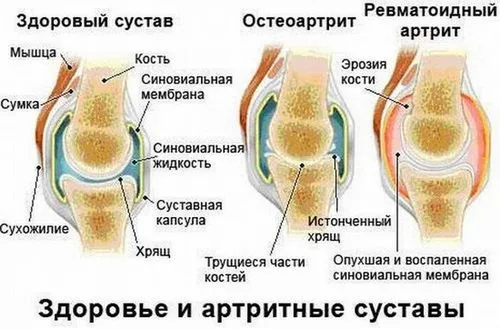 артрит і артроз в чому різниця