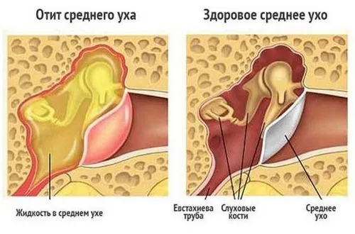 болить вухо всередині що робити ніж лікувати всередині народні засоби чому найчастіша причина чинники провокують у дітей лікувальні заходи перша допомога при гострій вушної профілактичні заходи відео