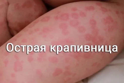 як довго лікувати кропивницю