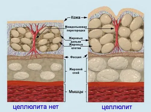 Целюліт (гиноидном липодистрофия) як лікувати набряклий целюліт