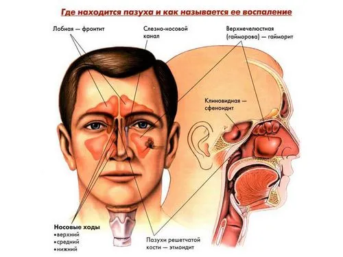 Чим відрізняється синусит від гаймориту: поширені симптоми синуситу і гаймориту як лікувати синусит гайморит