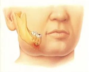 Fluxul dentare - cauze, simptome, tratament