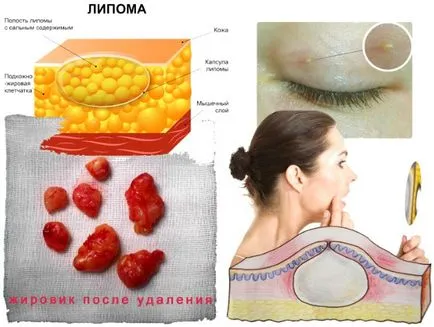 Wen (lipom) pe corpul cauzele simptomelor, tratamentul (e) pentru Wen (lipom) pe corpul cauzele, simptome, tratament