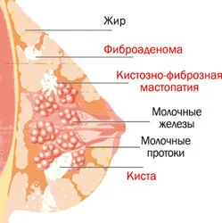 як лікувати мастопатію дифузну