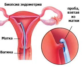 як лікувати ендометріоз шийки матки
