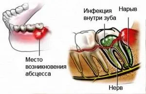 як лікувати флюс на щоці