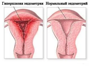 маткові кровотечі