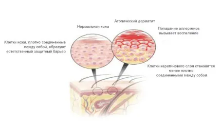 як лікувати дерматит на голові