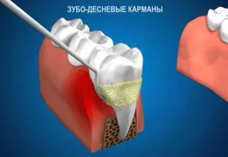 як лікувати кишені в яснах
