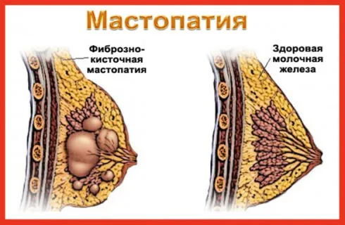 як лікувати мастопатію дифузну
