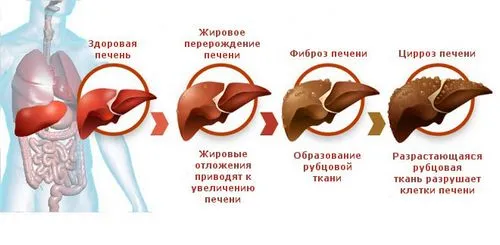 Цироз печінки лікуватися чи рак печінки