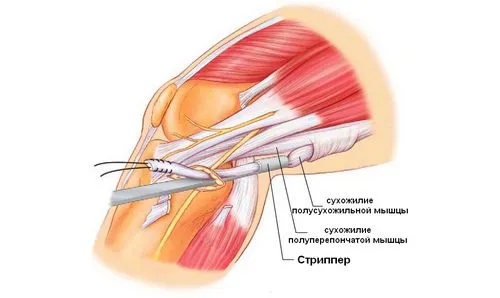як лікувати забій щиколотки