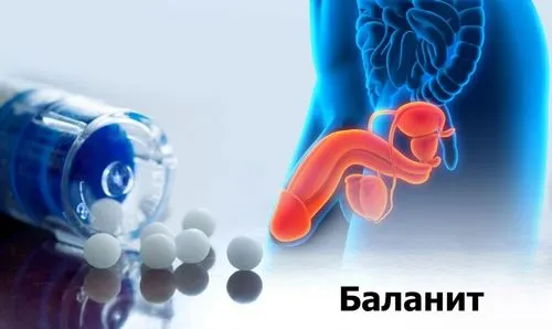 як лікувати цірцінарний баланопостит
