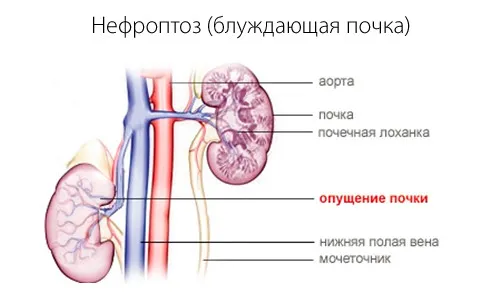 бандаж нирковий лікувати блукаюча нирка дієта нефроптоз