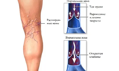 як лікувати варикоз вен народними засобами
