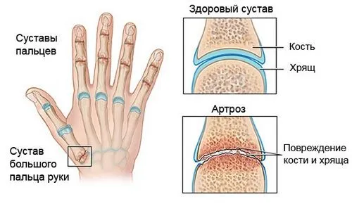 артроз причини симптоми стадії ускладнення лікування народні рецепти методи харчування профілактика захворювання препарати дієта суглоб
