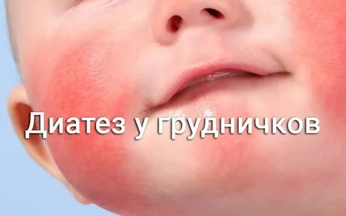 Діатез у грудічков: скільки проходить і як прискорити лікування? лікувати діатез немовлят народними засобами