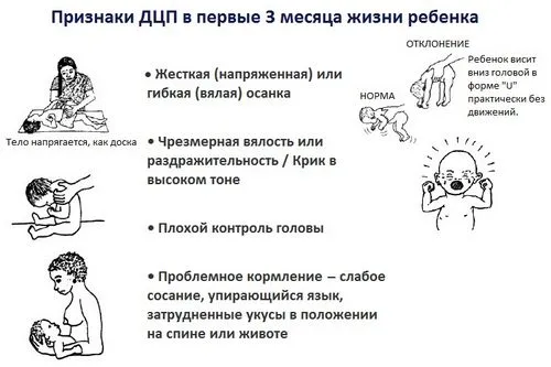 як лікувати ДЦП у дитини