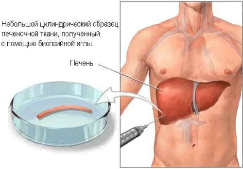 Цироз печінки лікуватися чи рак печінки
