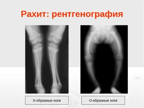 як лікувати починається рахіт